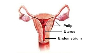 cara mengobati polip rahim agar bisa sembuh tanpa operasi